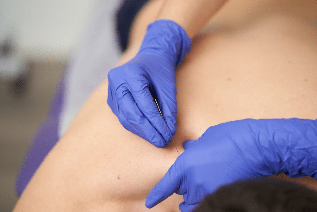 Dry Needling Therapy Redwater | Redwater Physical Therapy